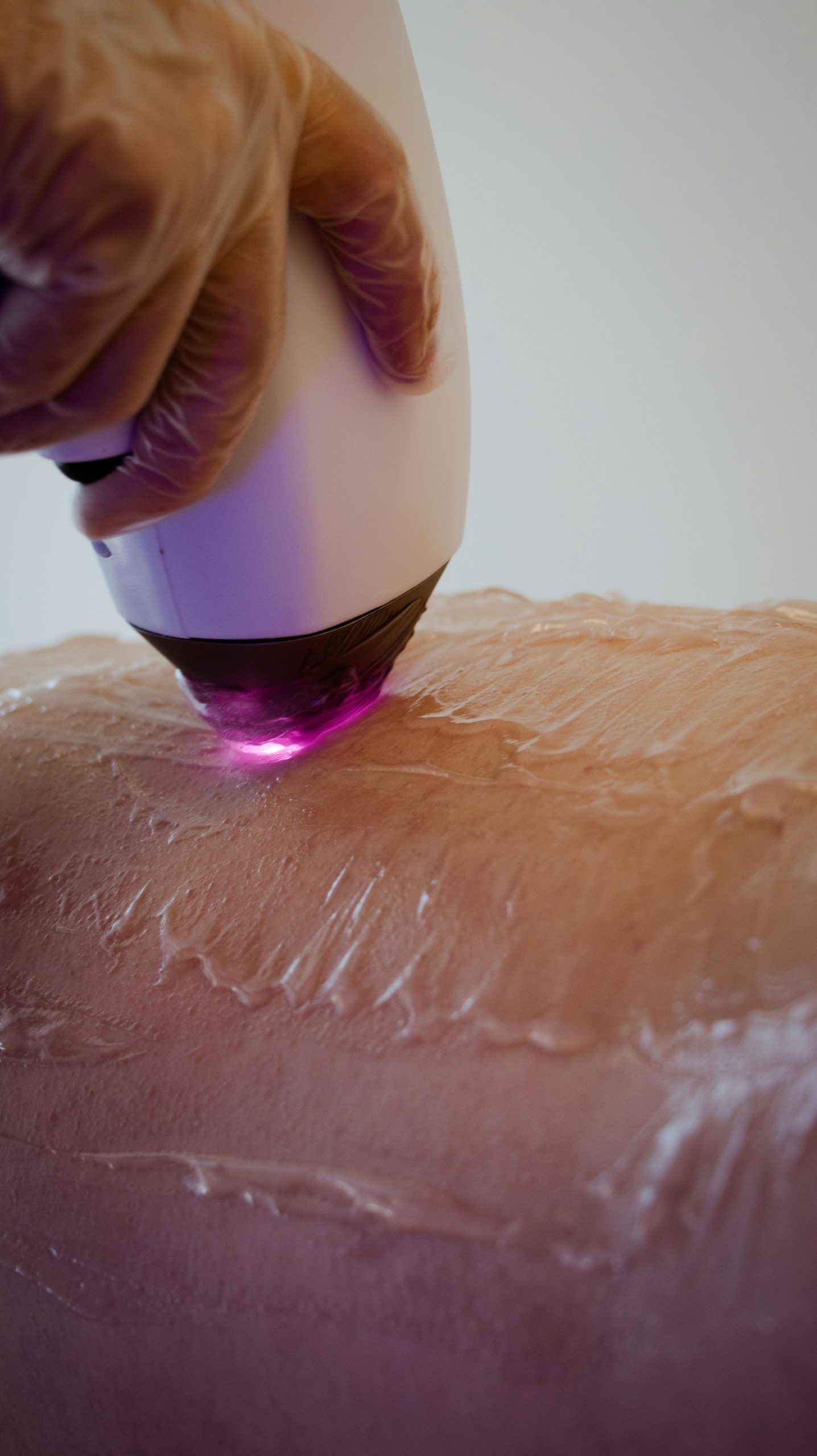The Benefits of Laser Hair Removal Over Traditional Hair Removal Methods