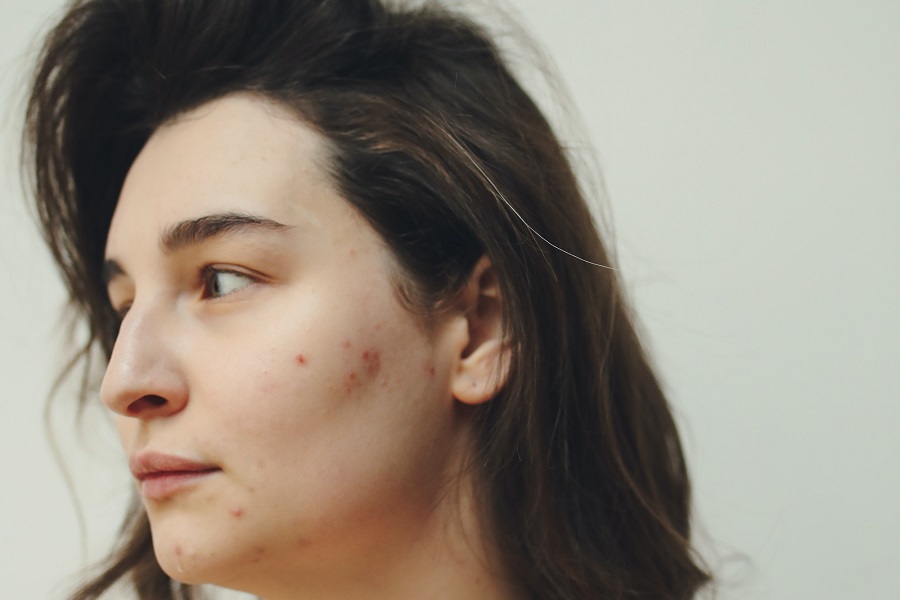 SKIN INFLAMMATION AND ACNE: WHAT’S THE CONNECTION?